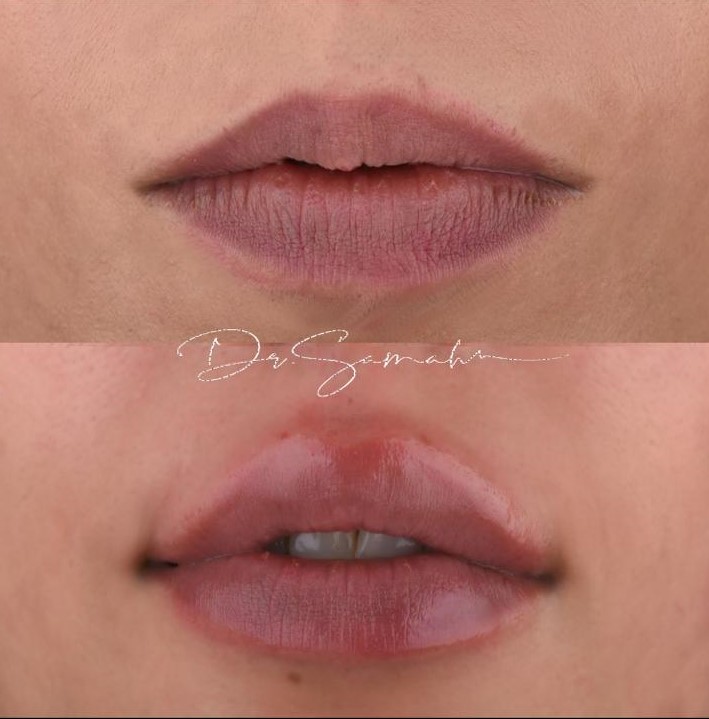 Read more about the article فلر- filler